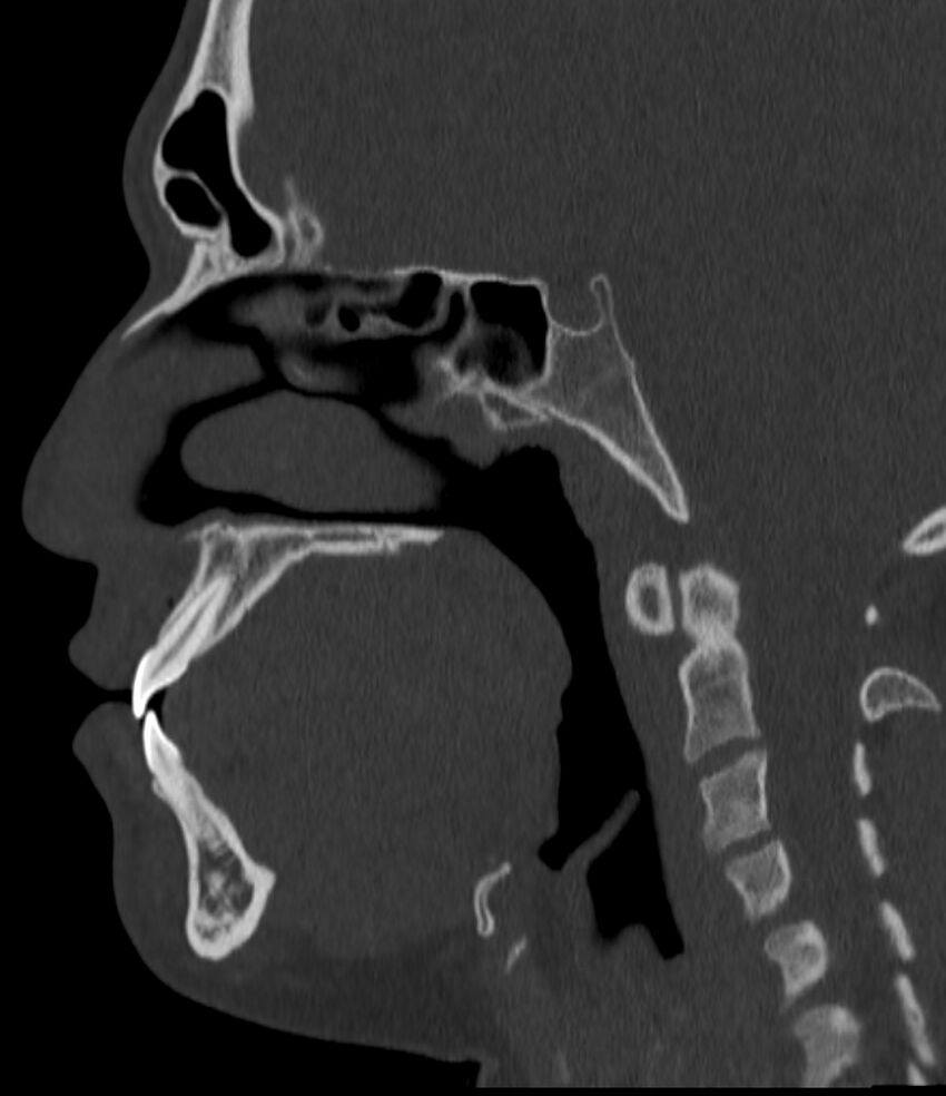 Normal facial bone CT (Radiopaedia 88742-105476 Sagittal bone window 84).jpg