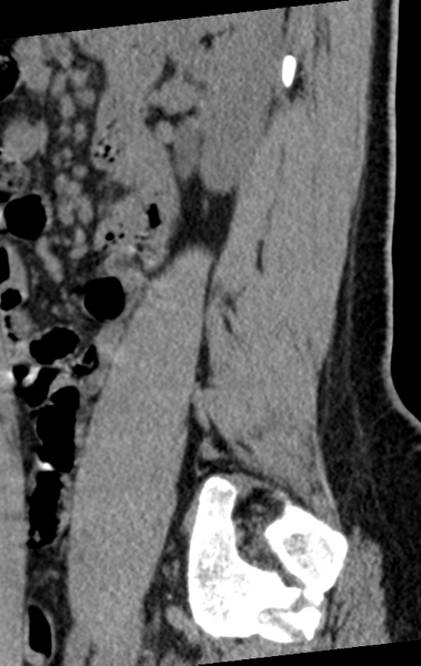 File:Normal lumbar spine CT (Radiopaedia 46533-50986 C 19).png