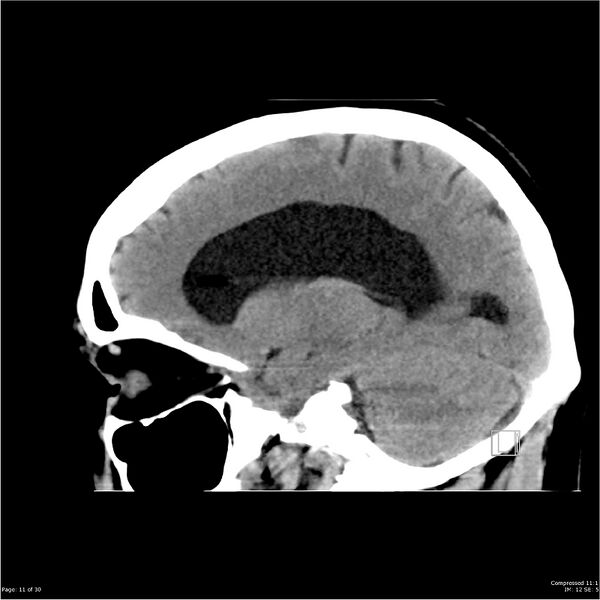 File:Normal pressure hydrocephalus (Radiopaedia 24415-24736 A 11).jpg