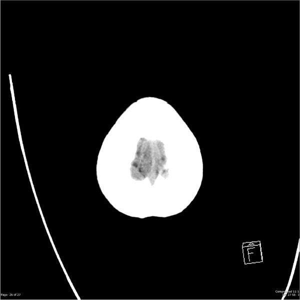 File:Normal pressure hydrocephalus (Radiopaedia 24415-24736 Axial non-contrast 23).jpg