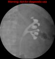 Normal retrograde pyelography of a native and transplant kidney (Radiopaedia 40480-43054 Native kidney 8).jpg