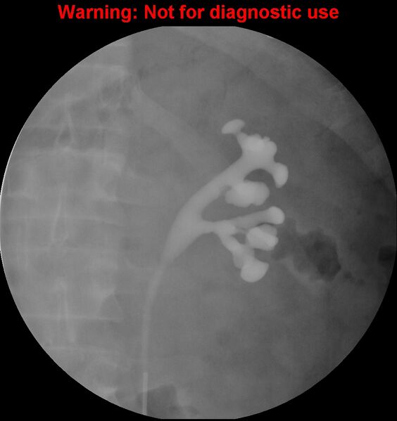 File:Normal retrograde pyelography of a native and transplant kidney (Radiopaedia 40480-43054 Native kidney 8).jpg
