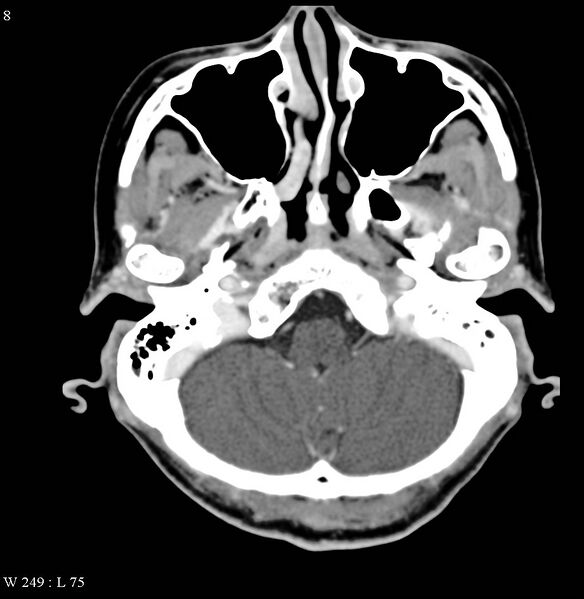 File:Occipital condyle metastasis - into mastoid (Radiopaedia 5424-7177 B 8).jpg