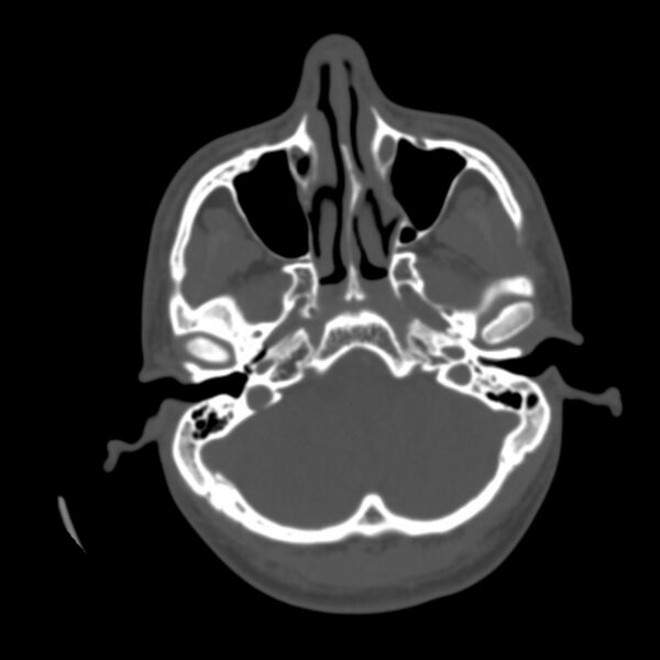 File:Occipital spur - asymptomatic (Radiopaedia 87753-104201 Axial bone window 25).jpg