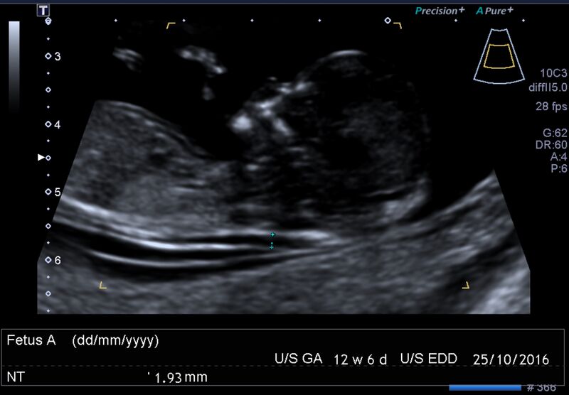File:1st trimester nuchal-morphology ultrasound (Radiopaedia 44706-48477 General anatomy and NT 4).jpg