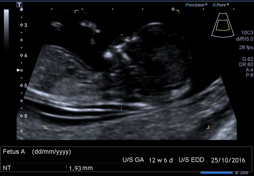 1st trimester nuchal-morphology ultrasound (Radiopaedia 44706-48477 General anatomy and NT 4).jpg