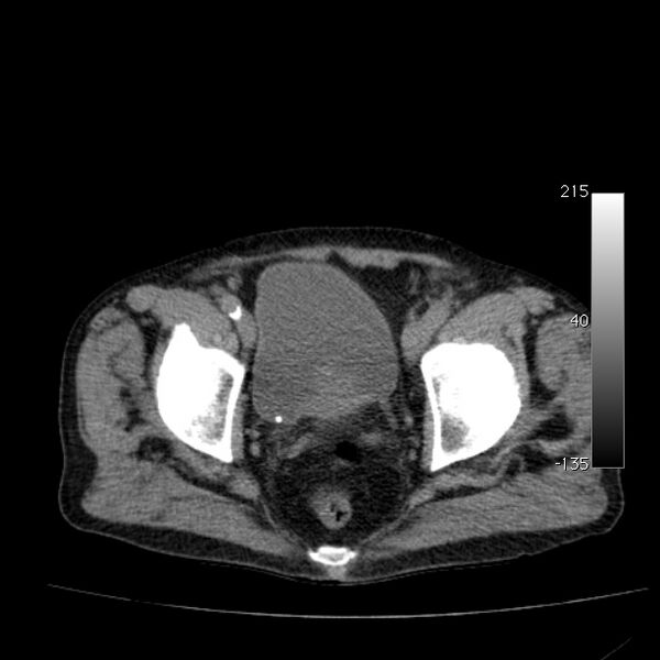 File:Abdominal aortic aneurysm (Radiopaedia 29248-29660 Axial non-contrast 52).jpg