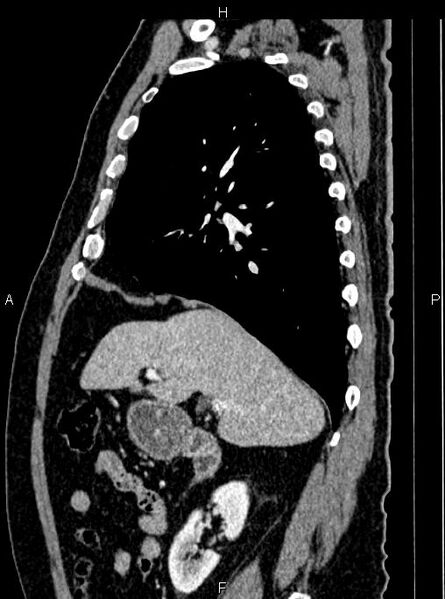 File:Abdominal aortic aneurysm (Radiopaedia 83094-97462 Sagittal renal cortical phase 44).jpg