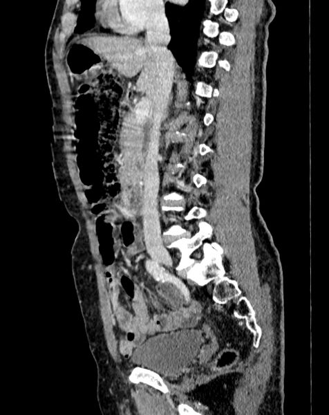 File:Abdominal aortic aneurysm (Radiopaedia 83581-98689 Sagittal C+ portal venous phase 31).jpg