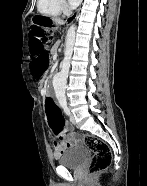 File:Abdominal aortic aneurysm (Radiopaedia 83581-98689 Sagittal C+ portal venous phase 55).jpg