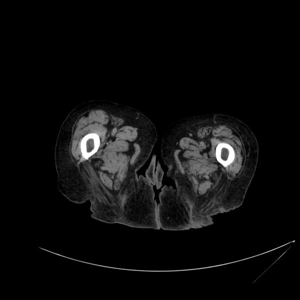 File:Abdominal aortic aneurysm - impending rupture (Radiopaedia 19233-19246 Axial non-contrast 149).jpg