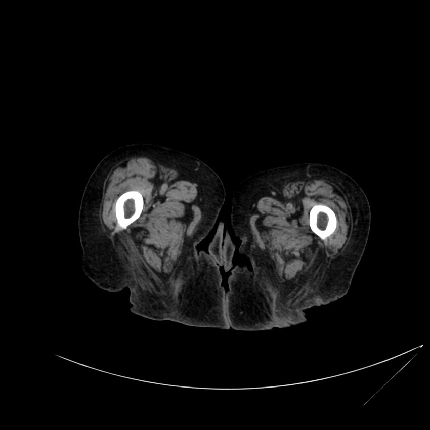 Abdominal aortic aneurysm - impending rupture (Radiopaedia 19233-19246 Axial non-contrast 149).jpg