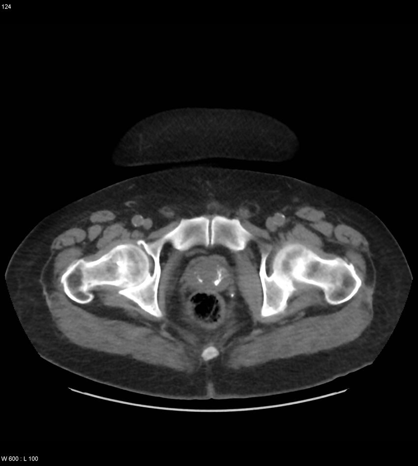 Abdominal aortic aneurysm with intramural hematoma then rupture (Radiopaedia 50278-55631 Axial non-contrast 120).jpg