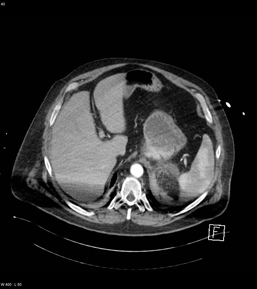 Abdominal aortic aneurysm with intramural hematoma then rupture (Radiopaedia 50278-55632 Axial C+ arterial phase 39).jpg