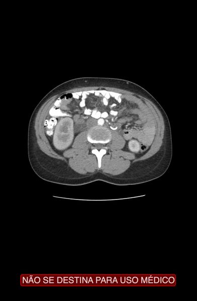 File:Abdominal desmoid tumor (Radiopaedia 44024-47540 Axial C+ arterial phase 14).jpg