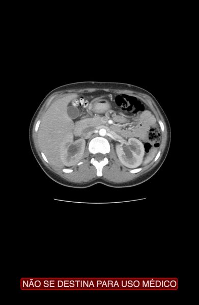 File:Abdominal desmoid tumor (Radiopaedia 44024-47540 Axial C+ arterial phase 2).jpg