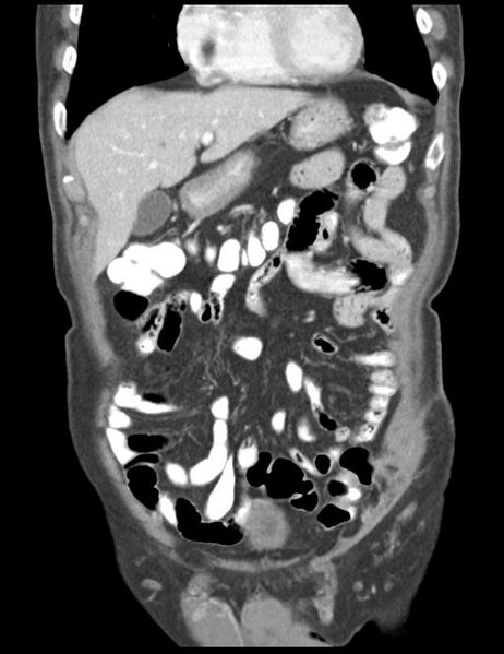 File:Abdominal wall metastasis from colorectal carcinoma (Radiopaedia 31016-31717 Coronal C+ portal venous phase 14).jpg