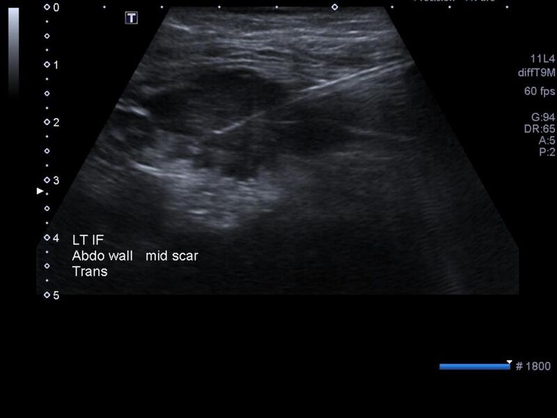 File:Abdominal wall metastasis from colorectal carcinoma (Radiopaedia 31016-31718 Transverse 6).jpg