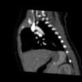 Aberrant left pulmonary artery (pulmonary sling) (Radiopaedia 42323-45435 Sagittal C+ arterial phase 36).jpg