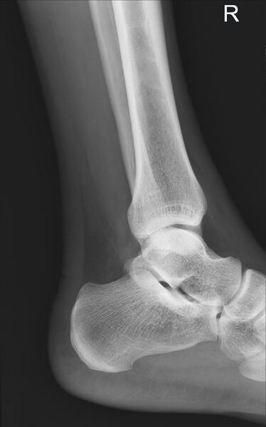 File:Achilles tendon tear (Radiopaedia 9759-10363 Lateral 1).jpg
