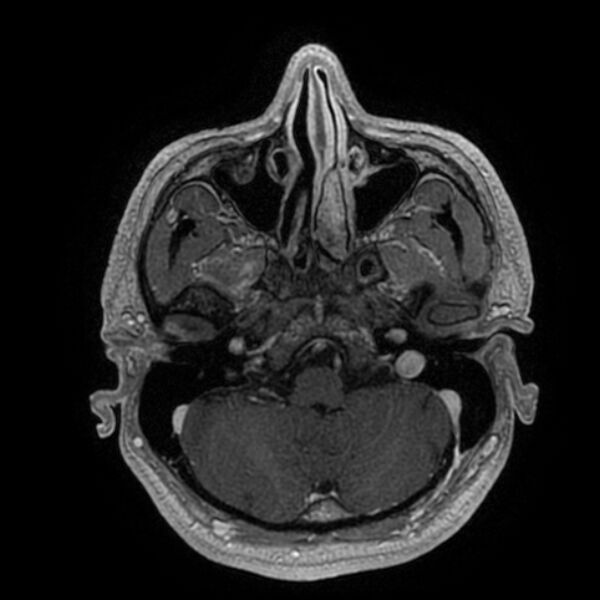 File:Acoustic schwannoma - intracanalicular (Radiopaedia 37247-39024 Axial T1 C+ 53).jpg