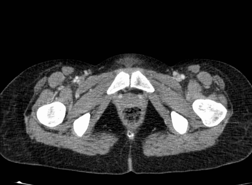 Acute Budd-Chiari syndrome (Radiopaedia 60858-68638 Axial C+ portal venous phase 305).jpg