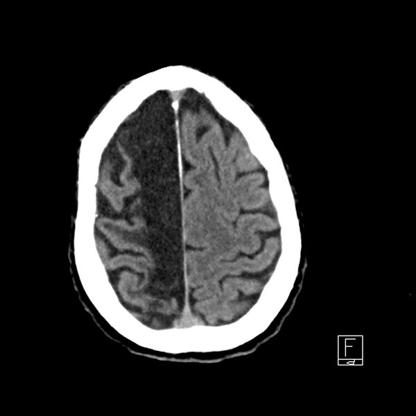 File:Acute ICA ischemic penumbra due to high-grade CCA stenosis (CT perfusion) (Radiopaedia 72038-82529 Axial non-contrast 39).jpg