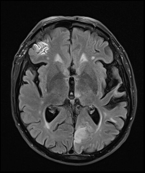 File:Acute P1 occlusion with PCA ischemia penumbra (CT perfusion) (Radiopaedia 72084-82590 Axial FLAIR 18).jpg