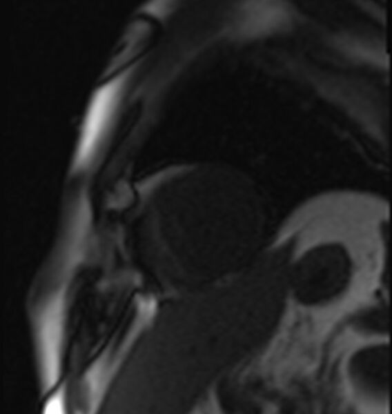 File:Acute anteroseptal myocardial infarction (Radiopaedia 68409-77945 Short axis (mid ventricular) Perfusion 3).jpg