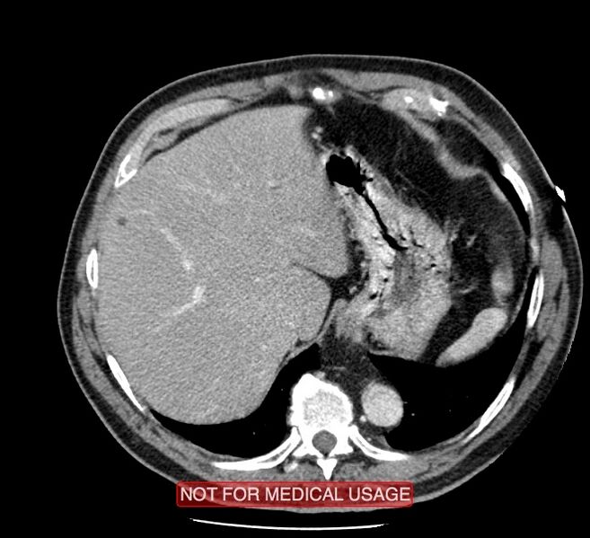 File:Acute aortic dissection - Stanford type A (Radiopaedia 40661-43285 Axial C+ portal venous phase 59).jpg