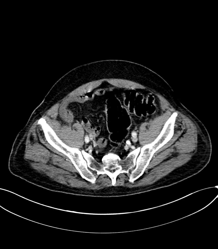 Acute arterial mesenteric ischemia (Radiopaedia 78238-90828 Axial C+ portal venous phase 114).jpg