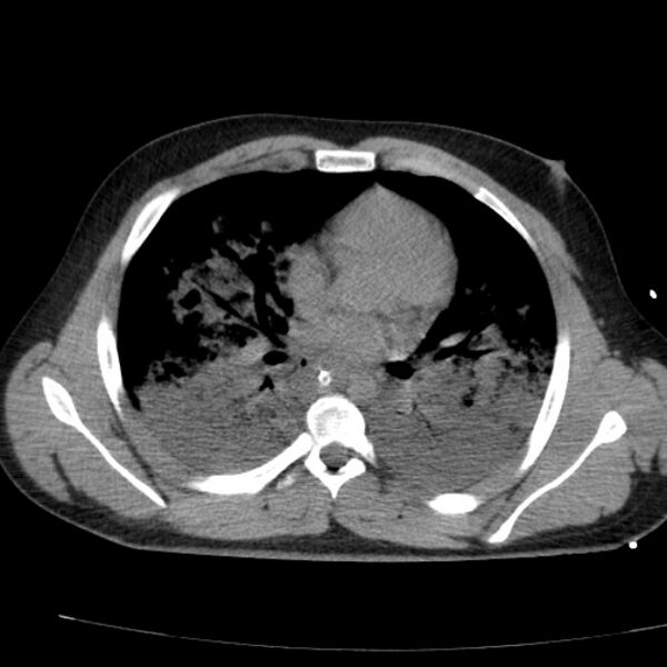 File:Acute aspiration pneumonitis (Radiopaedia 33605-34703 Axial non-contrast 48).jpg