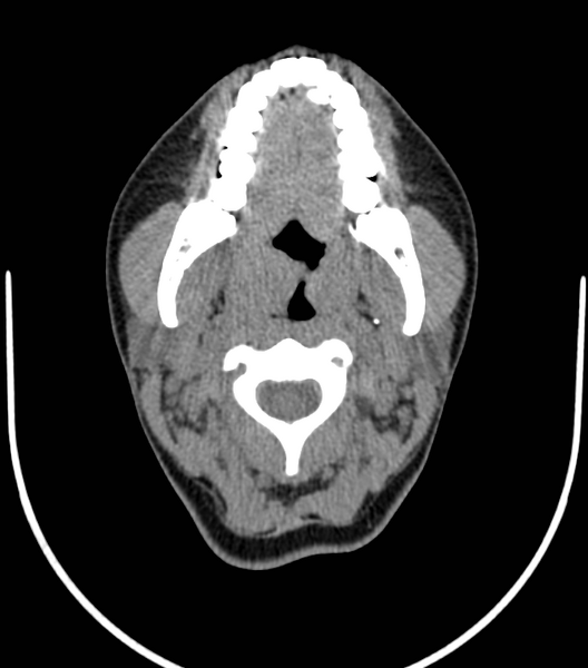 File:Acute bacterial tonsillitis (Radiopaedia 22882-22908 Axial non-contrast 17).png
