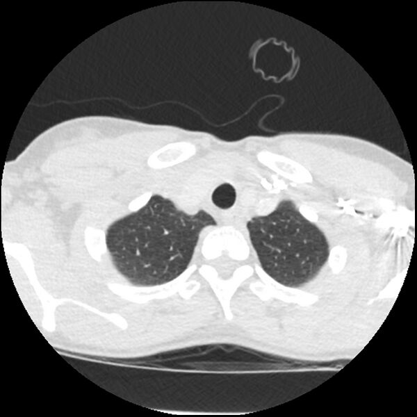File:Acute chest syndrome - sickle cell disease (Radiopaedia 42375-45499 Axial lung window 28).jpg