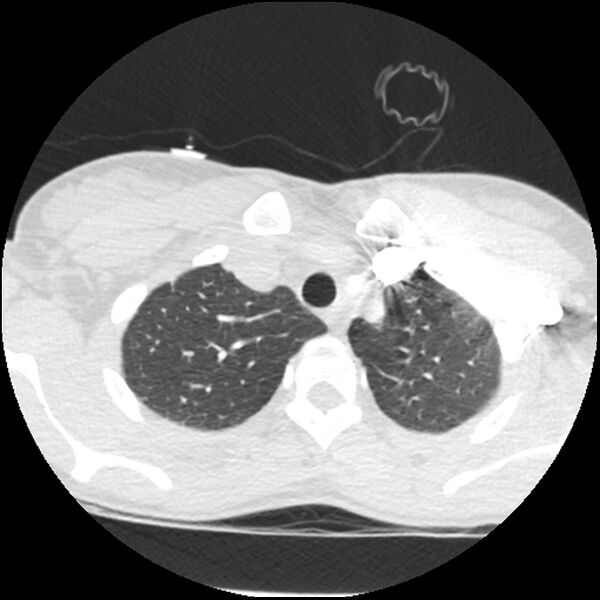 File:Acute chest syndrome - sickle cell disease (Radiopaedia 42375-45499 Axial lung window 37).jpg