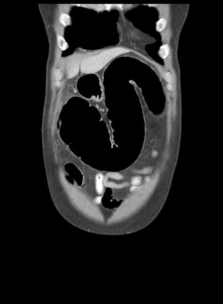 File:Acute cholecystitis (Radiopaedia 29814-30327 Coronal C+ portal venous phase 10).jpg