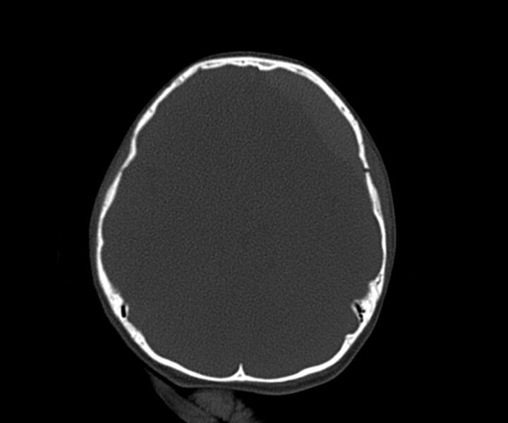 File:Acute epidural hematoma (Radiopaedia 63659-72335 Axial bone window 11).jpg