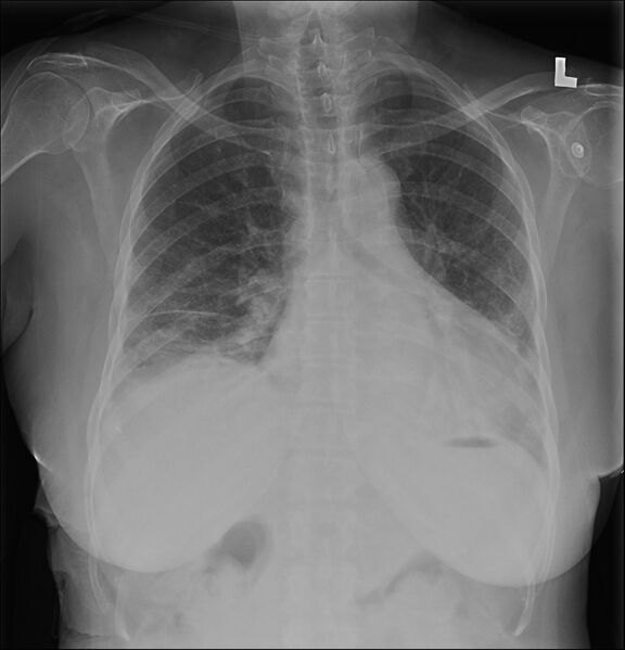File:Acute interstitial pneumonitis (Radiopaedia 45404-49443 Frontal 1).jpg