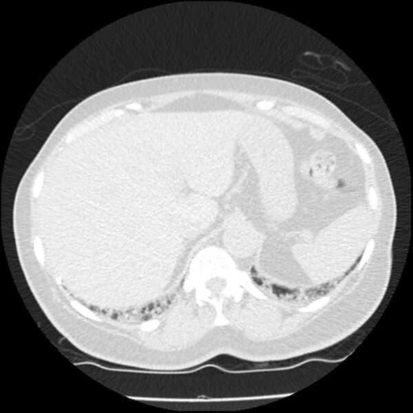 File:Acute interstitial pneumonitis (Radiopaedia 45404-49444 Axial lung window 92).jpg