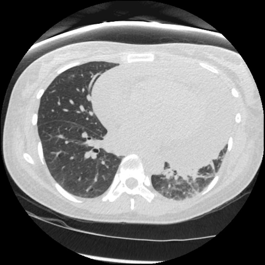 Acute lupus nephritis (Radiopaedia 45832-50107 Axial lung window 57).jpg