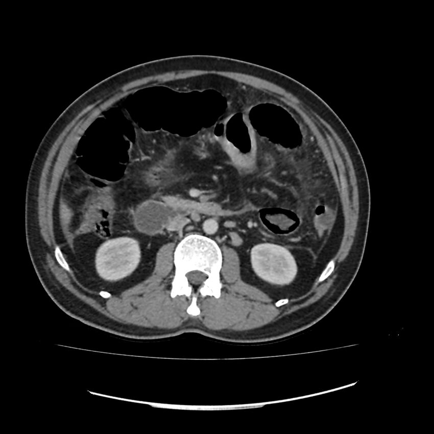 Acute mesenteric ischemia - superior mesenteric artery thrombosis (Radiopaedia 73947-84776 Axial C+ portal venous phase 56).jpg
