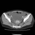 Acute myocarditis (Radiopaedia 55988-62613 Axial C+ portal venous phase 66).jpg