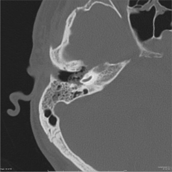 File:Acute otomastoiditis (Radiopaedia 28276-28512 Axial PTB bone window reformat 39).jpg