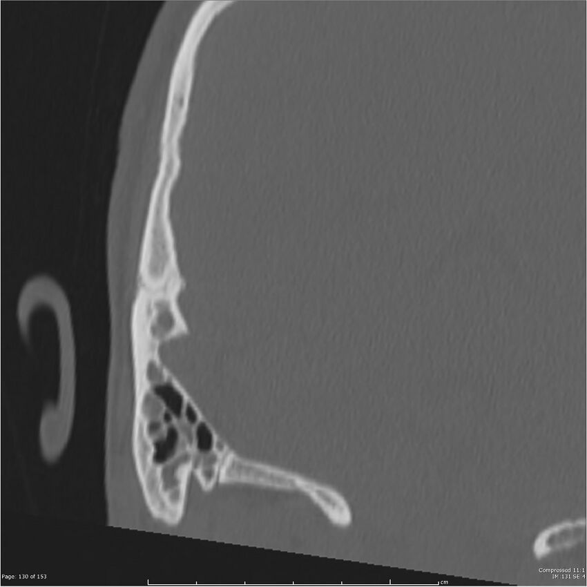 Acute otomastoiditis (Radiopaedia 28276-28512 Coronal PTB bone window reformat 61).jpg