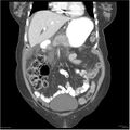 Acute pancreatitis (Radiopaedia 19136-19117 Coronal C+ portal venous phase 10).jpg