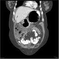 Acute pancreatitis (Radiopaedia 19136-19117 Coronal C+ portal venous phase 6).jpg