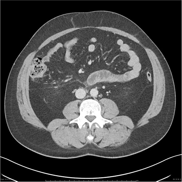 File:Acute pancreatitis - mild (Radiopaedia 27796-28033 C+ portal venous phase 31).jpg