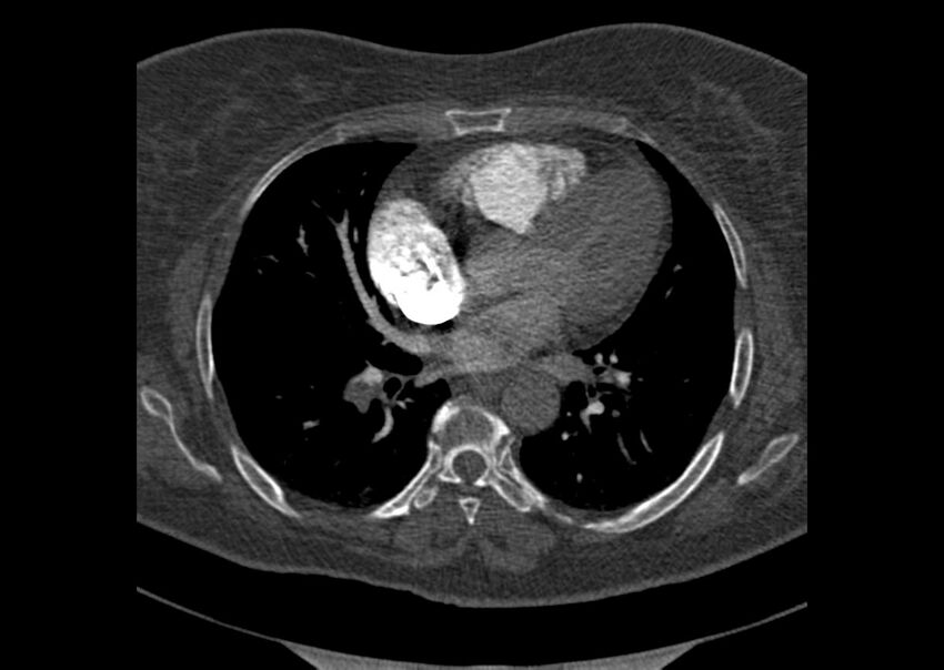Acute pulmonary embolism (Radiopaedia 29938-30466 Axial C+ CTPA 112).jpg