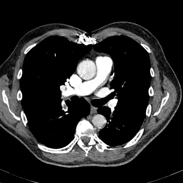 File:Acute pulmonary embolism (Radiopaedia 81677-95570 Axial C+ CTPA 41).jpg