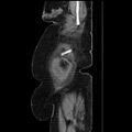Acute pyelonephritis (Radiopaedia 25657-25837 Sagittal renal parenchymal phase 14).jpg